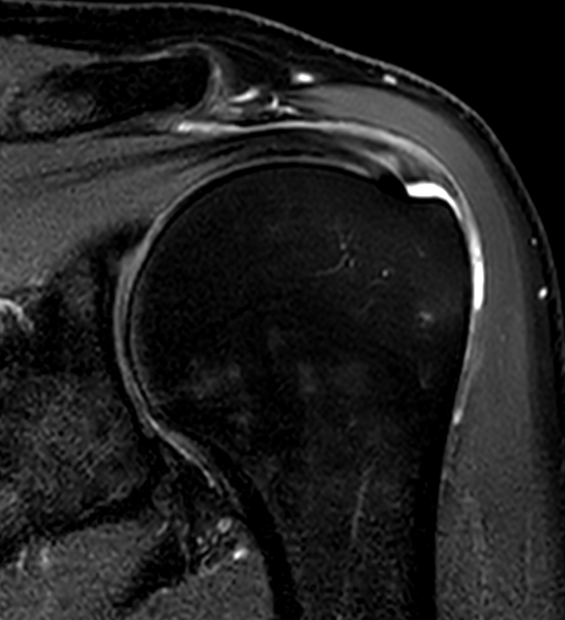 MRI